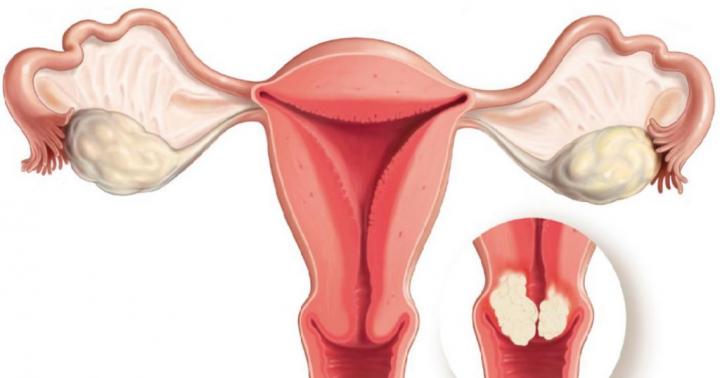 What are the symptoms of cervical blastoma?