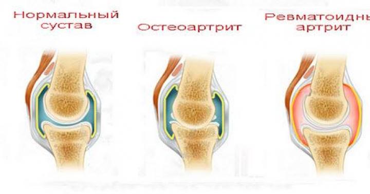 Diet for rheumatoid arthritis: what to eat and what not to eat?